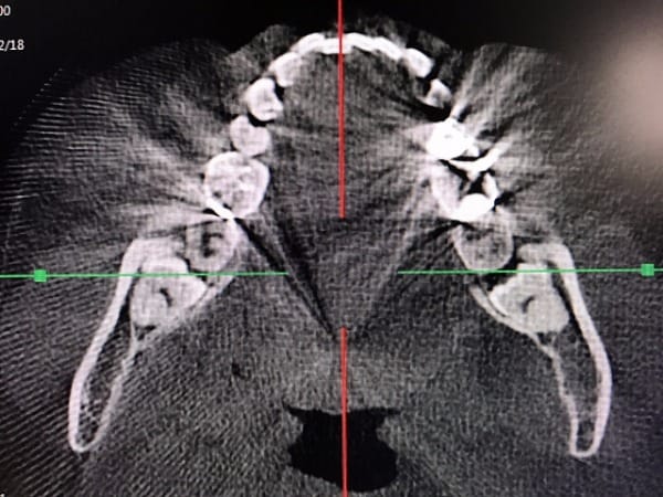 親知らずと神経の走行までしっかり見えます。画面下中央の黒いところは咽頭が見えています。