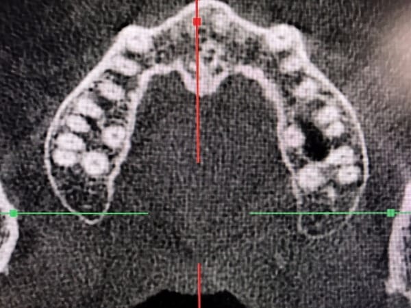 歯根の中の神経の管（根管）まで表示できています。